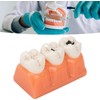 Tankredrug 4 Times Caries Evolution Model Detachable Teeth Disease Teach