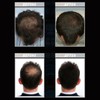 Hair Regrowth Pad Red Blue Lighting 99pcs Light Chips 15