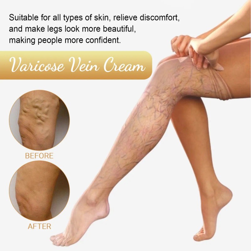 Crema Para Venas Varicosas,alivia Dolor Y Eliminar Varices*2