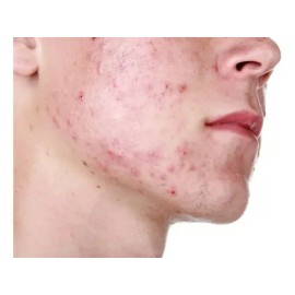 Treeactiv Crema Facial Acné Tratamiento Natural Promoción 3x