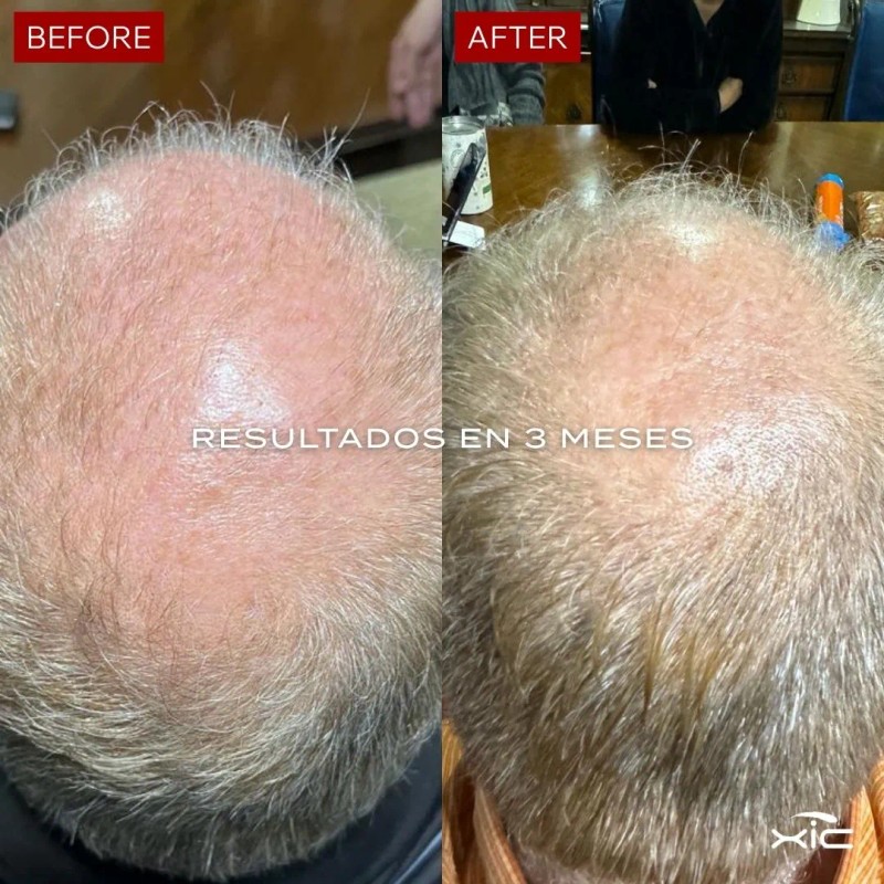 Suplemento Xic Glam Folix Anticada Y Crecimiento De Cabello