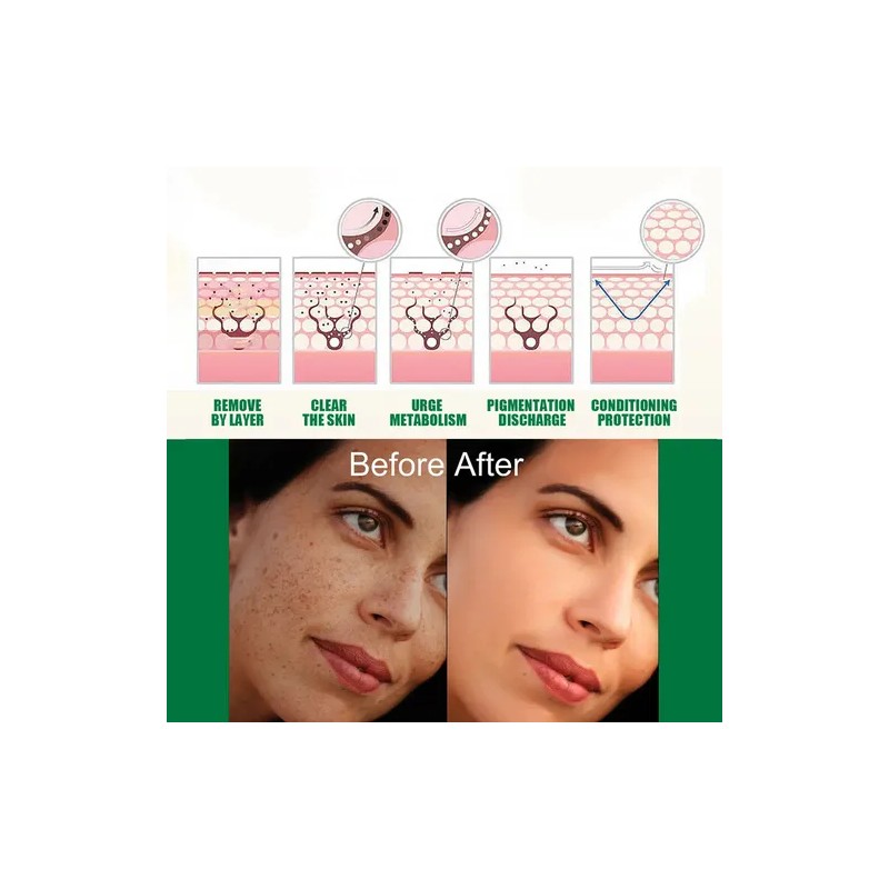 2×tratamento Manchas Escuras Tratamento Hiperpigmentação /