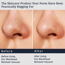 Blackhead Vacuum Pore Remover w Ion Nutrient Infusion, Firming, Lifting & LED Display- Gentle Face Suction Pore Cleanser - Electric Whitehead & Acne Extractor Tool w 3 Adjustable Suction & 6 Probes