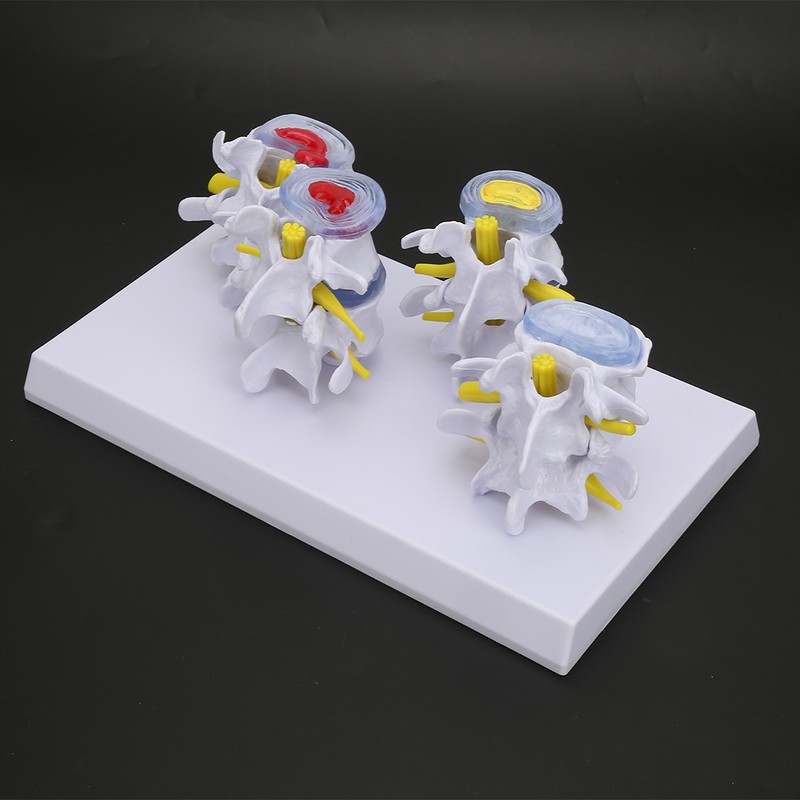 4-stage Medicals Human Lumbar Vertebrae Combination of Normal and Pathological