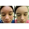 Mascarilla Facial Arcilla + Jabón De Azufre Limpieza Facial.