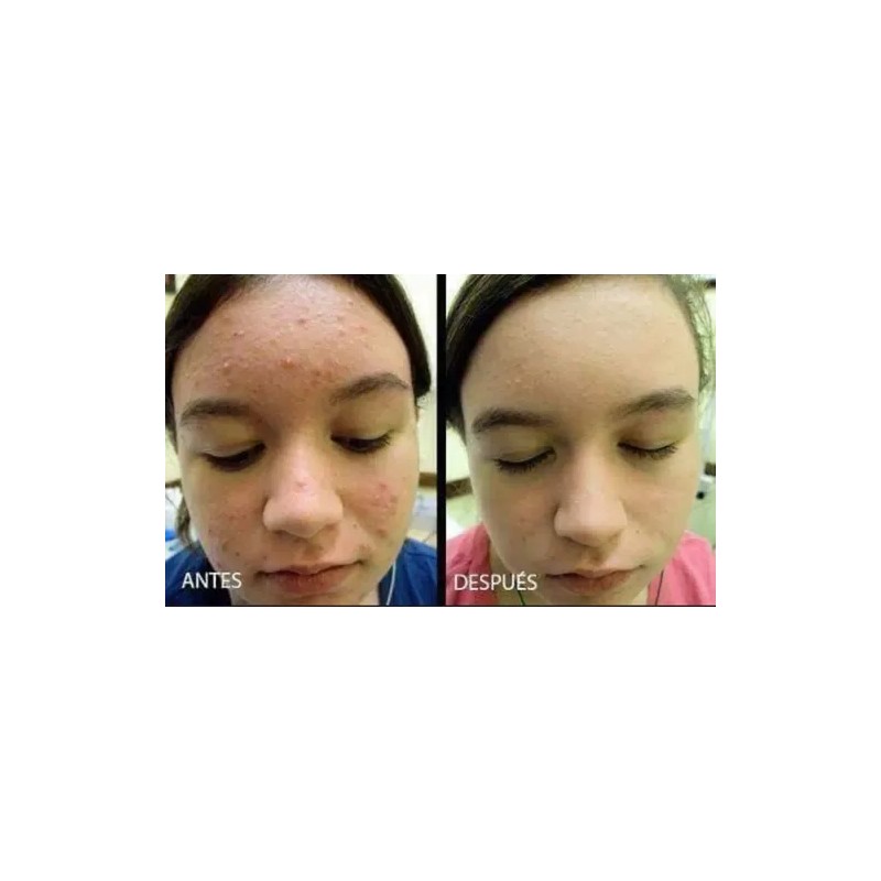 Mascarilla Facial Arcilla + Jabón De Azufre Limpieza Facial.