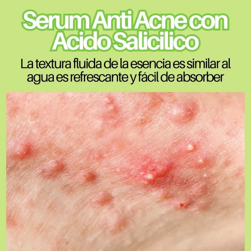 Suero Tratamiento Facial Contra Acné Ácido Salicílico 30ml F Todo