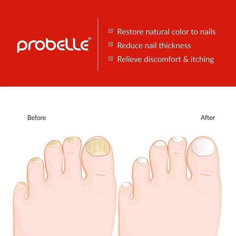 Probelle Tratamiento Natural Para Hogos En Las Uñas.