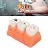 Tankredrug 4 Times Caries Evolution Model Detachable Teeth Disease Teach