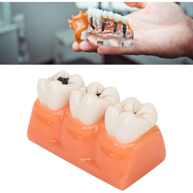 Tankredrug 4 Times Caries Evolution Model Detachable Teeth Disease Teach