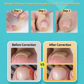 Zanchara Ingrown Toenail Treatment, 60Pcs Breathable Ingrown Toenail Strips,Painless Ingrown Toenail Tool for Nail Removal & Care, At-Home Pedicure Solution (Shape E)