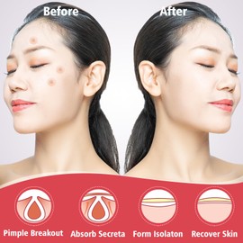 450 Pimple Patches for Face, Hydrocolloid Acne Patches for Zit Covers, Mighty Patch Acne Invisible Zit Patches for Face, 4 Sizes