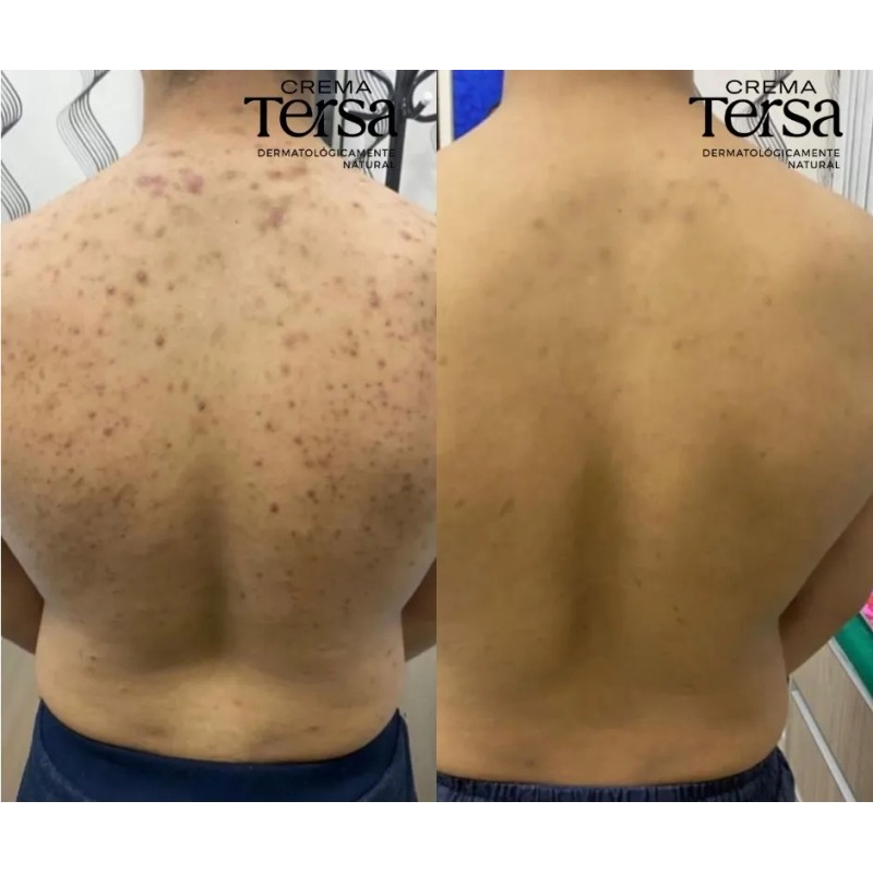 Crema Despigmentante Quita Manchas Acné Paño Vitíligo 30g Todo Tipo