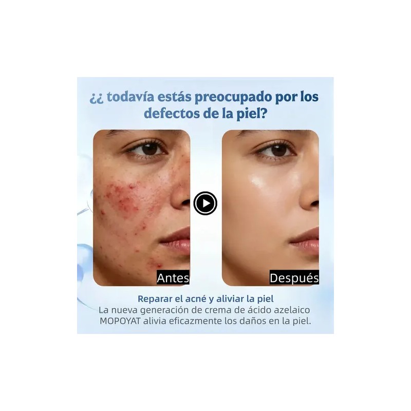 Ácido Azelaico Crema Con 20% Vitamina C Y Niacinamida Todo