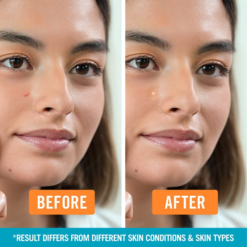 Nexcare™ Acne Blemish Covers, 72 Units/Pack