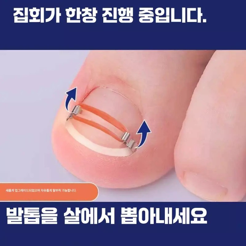 내성발톱교정기 발톱교정기 엄지발톱 내성손톱 [교정기 2개] Ingrown Toenail Correction Device,