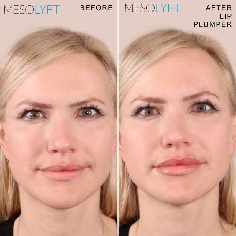 Mesolyft Neck & Lip Plumper Combo with Roller to Instantly