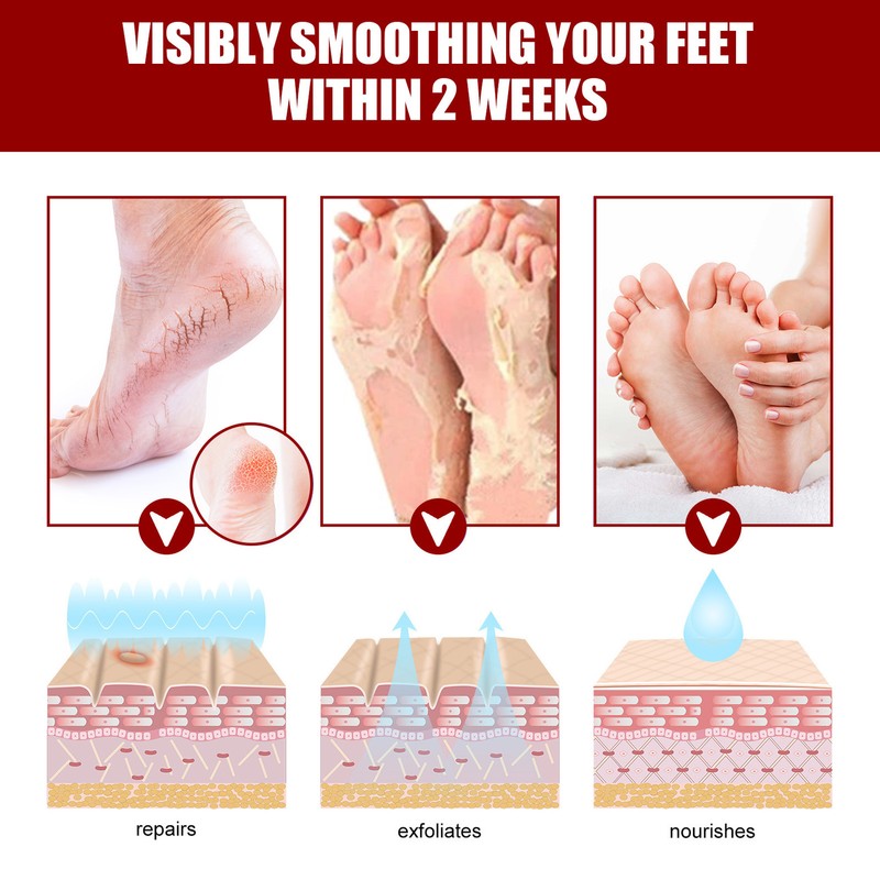 5 Pieces Exfoliating Foot Peel Mask Hydrating Moisturizing Smoothing for