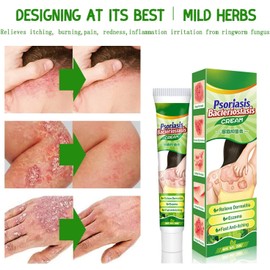 Crema Natural A Base De Hierbas Antipicazón, Crema Para Psoriasis Y Eczema, Cremas Hidratante Para Piel Seca, Con Picazón, Picaduras, Erupciones (paquete de 1)