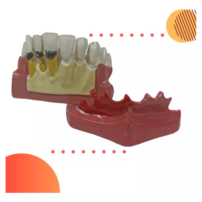 Den Med Modelo Dental Gingivitis