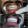 Crystal Clear 2021 CRYSTAL CLEAR TEETH WHITENING ALL-IN-1 No Sensitivity,
