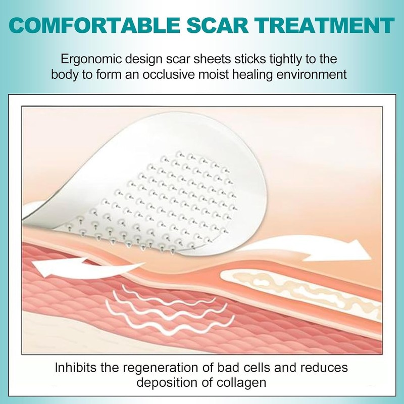 Extra Long Silicone Scar Sheets (1.6” x 200” Roll-5M), Silicone