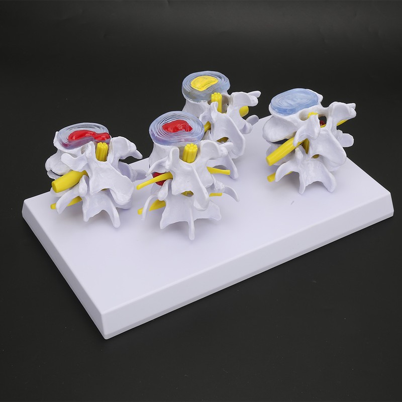 4-stage Medicals Human Lumbar Vertebrae Combination of Normal and Pathological