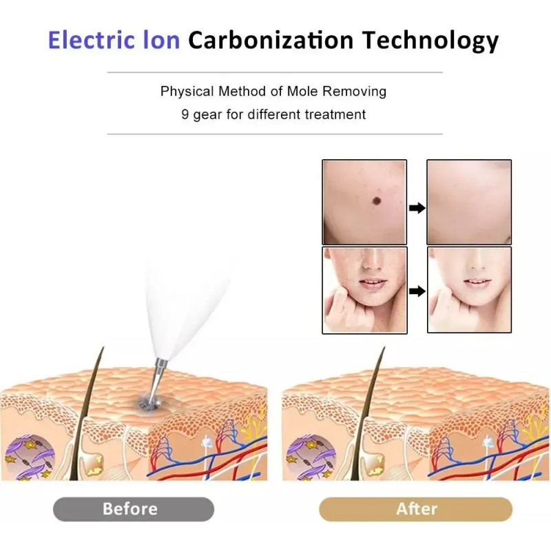 Maquina De Plasma Para Quitar Verrugas Genitales Sin Dolor