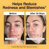 Foundation Skincare Ácido Azelaico Para La Cara 14% (1 Onza