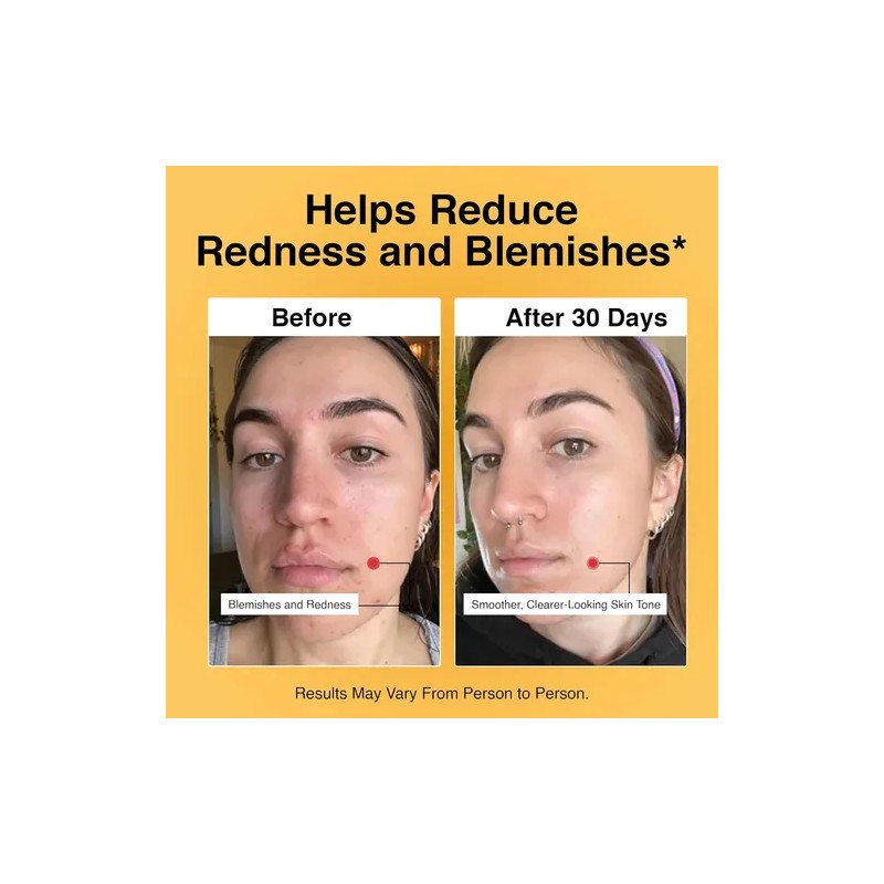 Foundation Skincare Ácido Azelaico Para La Cara 14% (1 Onza