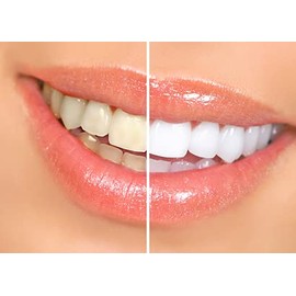 Beauty Deals Teeth Whitening Kit 35% Carbamide Peroxide 10x 3cc Syringes and Mouth Trays