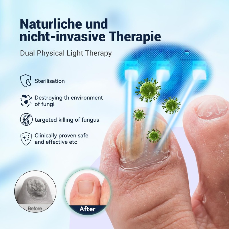 IUHFSIFS 426BWUZHID Nail Fungus Laser Device VUIYH
