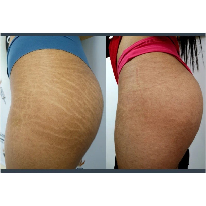 Crema Corporal Anticelulitis Y Estrías Reafirmante 300ml Neutra