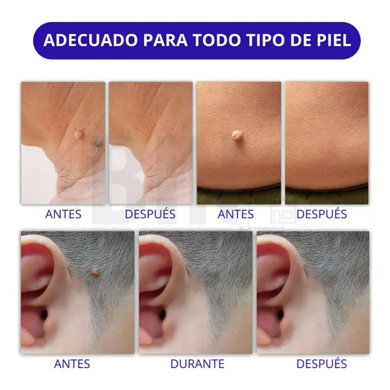 Parches Aliver Antiacné Pack 180 Unidades Día/noche Todo Tip