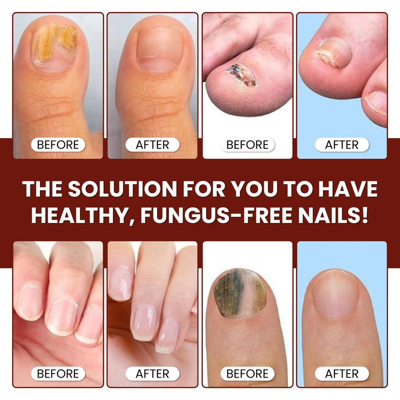 Abera Maximum Strength Nail Repair Serum - Intensive Care for
