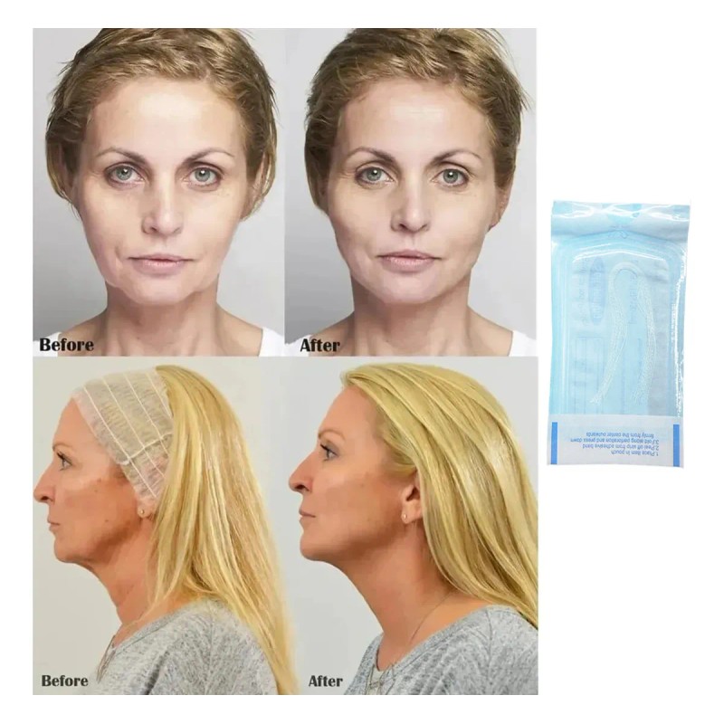 🔥 300 de colágeno absorbible de hilo de estiramiento facials