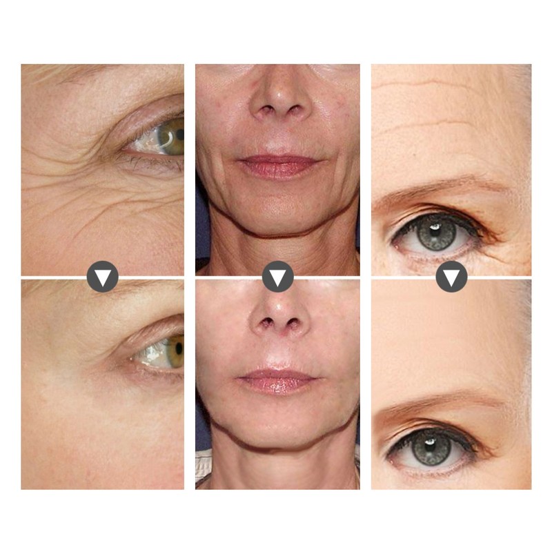 Forehead Wrinkle Frown Lines Removal Sticker Patch Moisturizing Nasolabial Folds