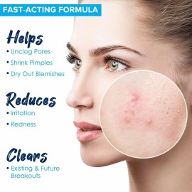 Amire Blemish Drying Lotion, Acne Spot Treatment Skincare Formula for Teens...