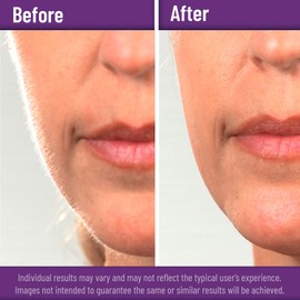 Disposable #10 and #11 Scalpel Blades, Pack of 20 Dermaplaning Blades w. Plastic Handle, Surgical Knife Scalpel, Carbon Steel Dermablade Surgical Blades Individually Wrapped 10x#10, 10x#11 Blade