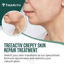 TreeActiv Crepey Skin Repair Treatment Original Formula, 8 fl oz, Firming Cream For Face & Neck, Skin Firming Lotion with Hyaluronic Acid, Crepey Treatment to Address Dry Crepe