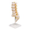 3B Scientific A76/5 Lumbar Spinal Column with Dorso-Lateral Prolapsed Intervertebral