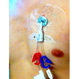 PICC Moisture Barrier for Shower - Transparent Film Wound Dressing Protection Cover, 4 x 4 Inch (28 Pcs)