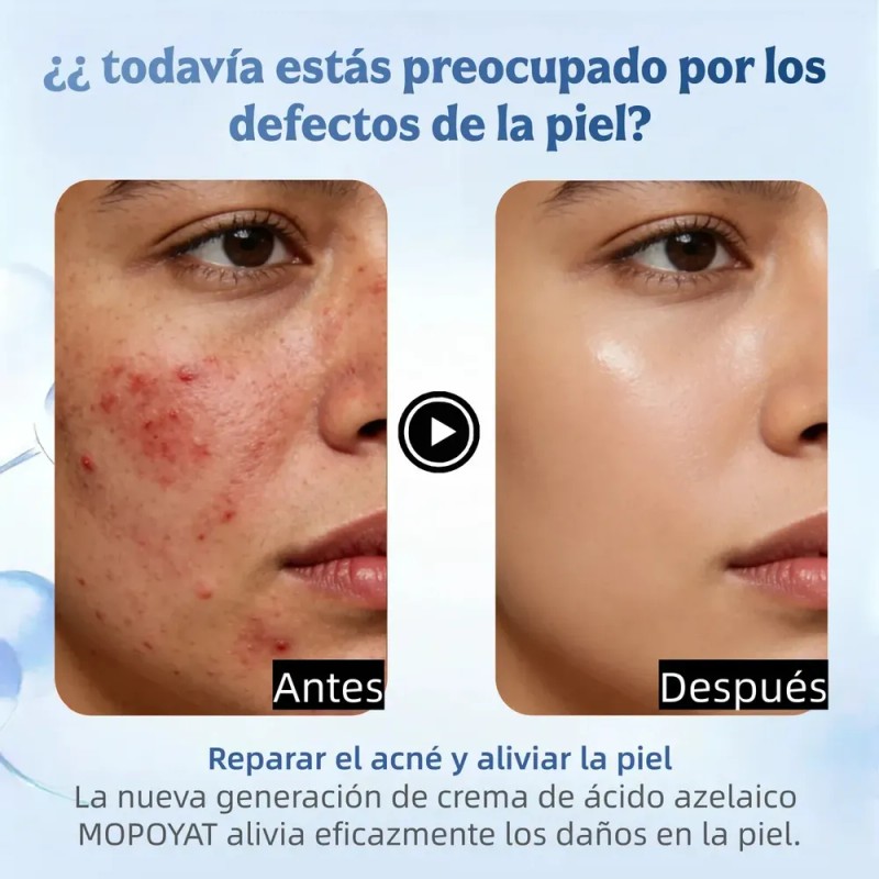 Ácido Azelaico Crema Con 20% Vitamina C Y Niacinamida