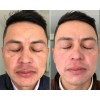 Crema Despigmentante De Paño Melasma Acne