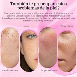 7.0 + TXA 4.0.CREAM Crema de manchas faciales,2pcs Cremas de manchas faciales,Crema de aclaramiento de la piel,manchas oscuras, pecas，pigmentación