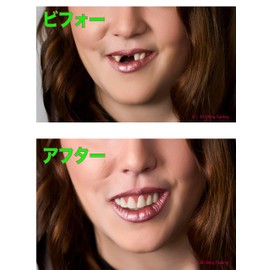 Instantsmile DX-M Instant Smile Teeth, 1 Piece