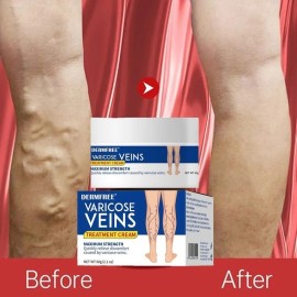 DERMFREE Treatment Legs Varicose Veins Cream Vein Care Fading Cream Herbal Ointment 60g