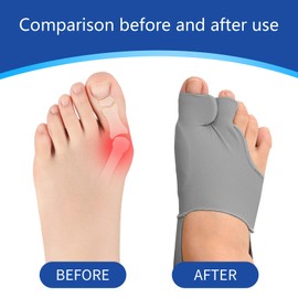 DiviDermy Pack of 2 Hallux Valgus Correction, Hallux Valgus Bandage with Heel Band, Non-Slip Bunion Corrector, Toe Separator for Men and Women, Suitable for Most Shoe Types, Skin