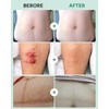 Hydrocolloid Roll for Wound Care - Cut-to-Size, Extra Large Medical-Grade