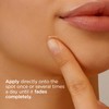 ISDIN Acniben On The Spot, Facial Pimples Corrector Drying Gel,